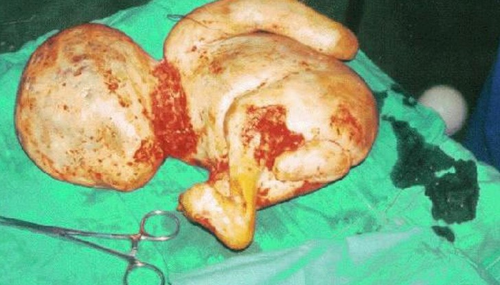 Откриха вкаменено бебе на 44 години в утробата на баба Откриха вкаменено бебе на 44 години в утробата на баба