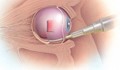 Инжекция в окото пази от слепота