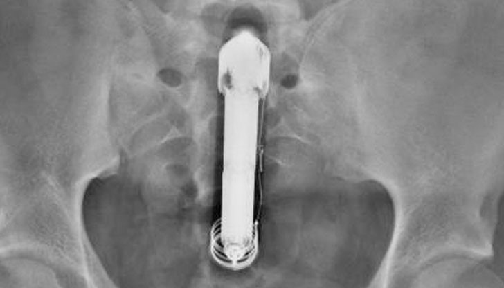 Лекари вадят работещ вибратор от мъж