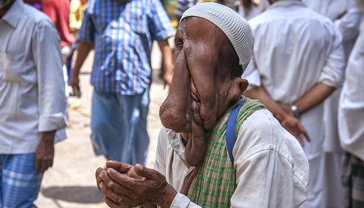 Човекът-слон отказа ново лице, за да плати сватбата на дъщеря си