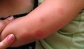 Как да спрете сърбежа след ухапване от комар на мига