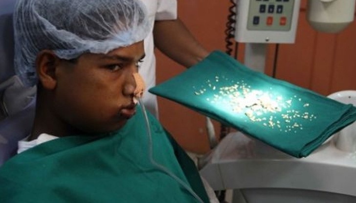 Извадиха 232 зъба от устата на 17-годишно момче