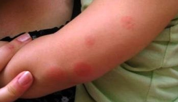 Как да спрете сърбежа след ухапване от комар на мига