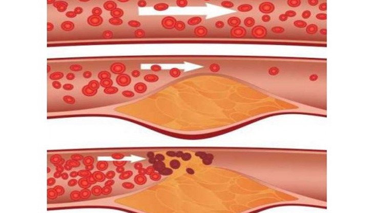 Ето как да прочистим кръвоносните съдове с много лесна рецепта Ето как да прочистим кръвоносните съдове с много лесна рецепта