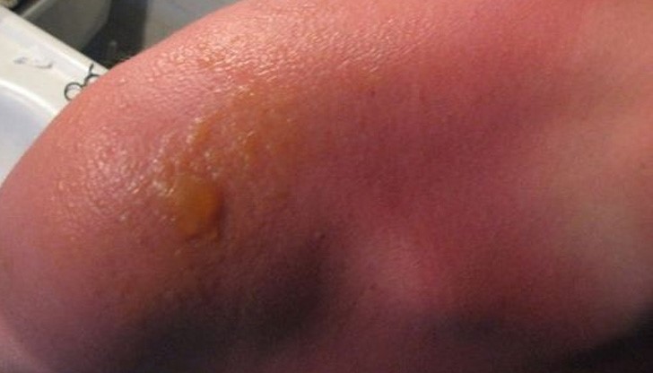 Изгорили сте се - спрете болката моментално с този трик