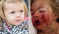 Лекари едва спасиха живота на 2-годишно дете заради "Нурофен"