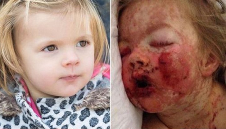 Лекари едва спасиха живота на 2-годишно дете заради "Нурофен" Лекари едва спасиха живота на 2-годишно дете заради "Нурофен"