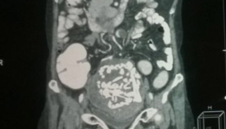 Жена носи 36 години ембрион в тялото си Жена носи 36 години ембрион в тялото си