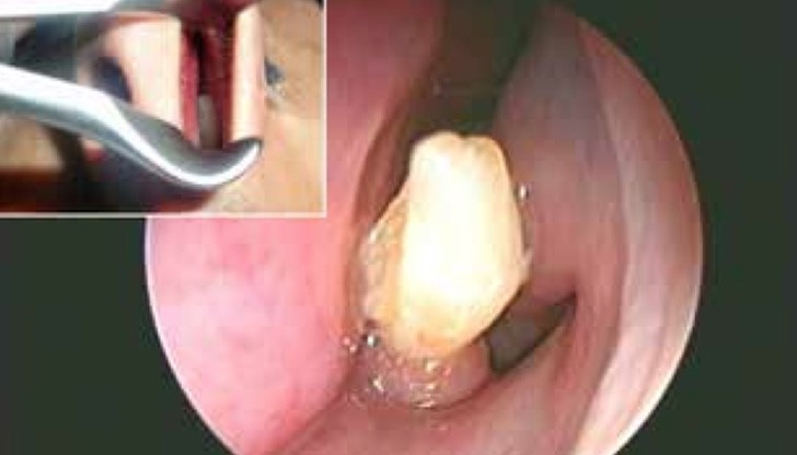 Няма да повярвате какво откриха в носа на мъж от Саудитска Арабия