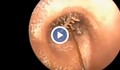 Лекари откриха щурец в ухото на мъж