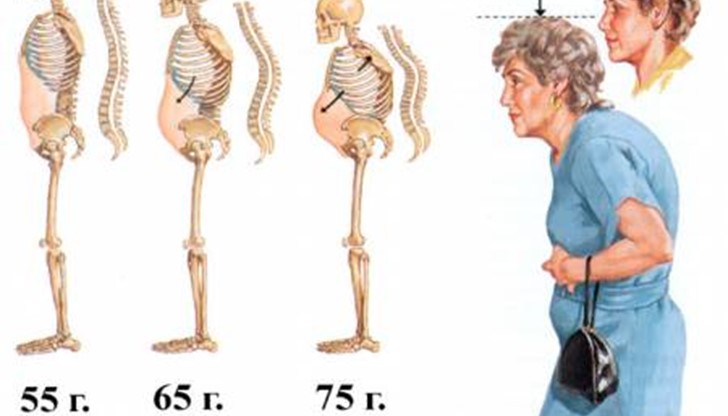 Приблизително една от всеки три жени и един от всеки петима мъже над 50 г. възраст получават остеопорозна фрактура