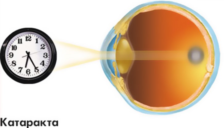 На пациентите ще бъде направен и профилактичен преглед за катаракта