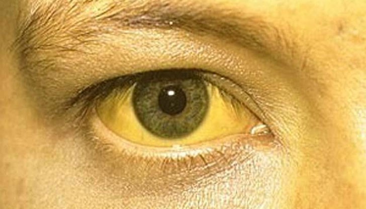 От заболяването, наричано още „болест на мръсните ръце", са се разболели 10 деца от 6 семейства от квартал в Дулово От заболяването, наричано още „болест на мръсните ръце", са се разболели 10 деца от 6 семейства от квартал в Дулово