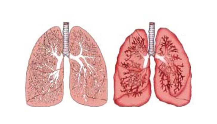 В България всеки 33-ти човек е носител на дефектен ген причиняващ Муковисцидоза В България всеки 33-ти човек е носител на дефектен ген причиняващ Муковисцидоза
