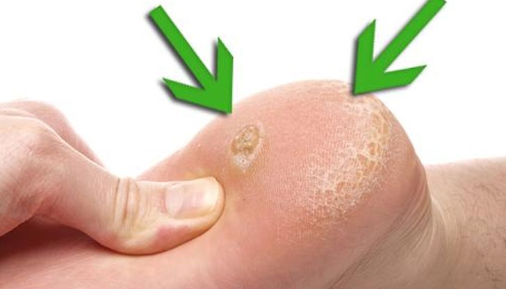 Домашния метод за ефективно премахване на мазолите от краката