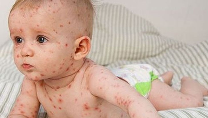 Близо 1000 болни само за седмица регистрираха епидемиолозите, васкина няма