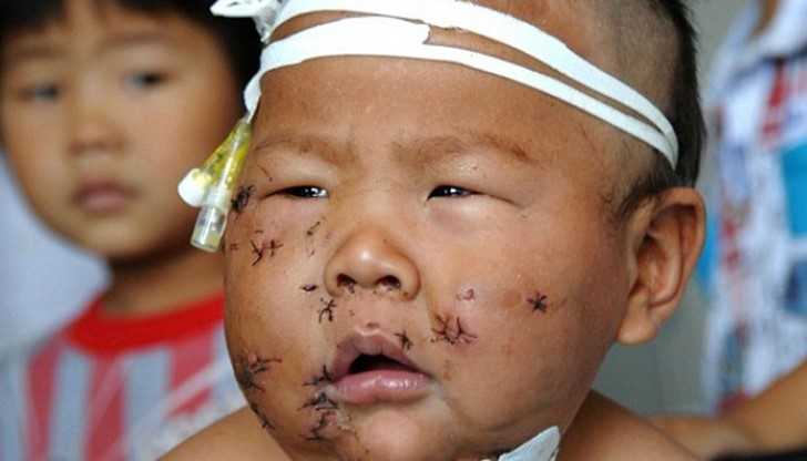 Убожданията са най-вече по лицето на бебето и са били нужни повече от 100 шева, за да се затворят раните