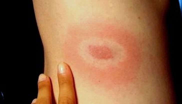 Мъжът е в тежко състояние в инфекциозната клиника на университетската болница "Св. Георги" Мъжът е в тежко състояние в инфекциозната клиника на университетската болница "Св. Георги"