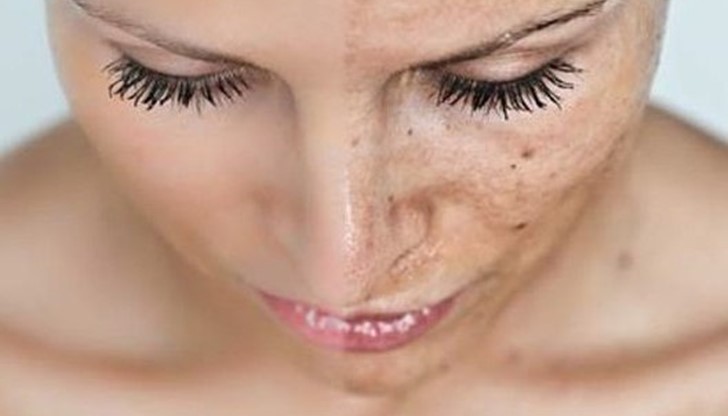 Освен предлаганите в аптечната мрежа продукти има и натурални средства, които успешно могат да ви помогнат