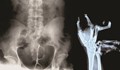 Вижте най-шокиращите рентгенови снимки в медицината