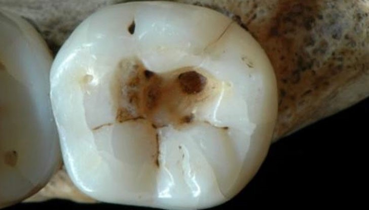 Древните хора също са имали проблеми със зъбите