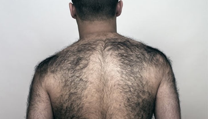 Хипертрихоза или свръхокосмяване е състояние включващо ...