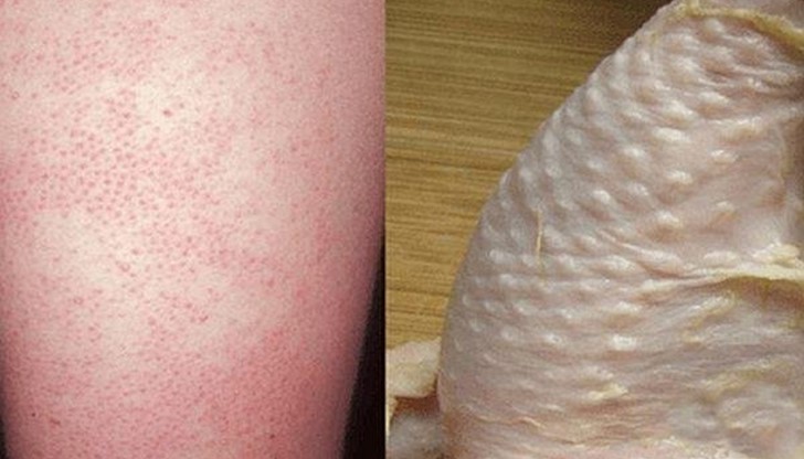 Знаете ли, че кератоза пиларис, известна още като "пилешка кожа"