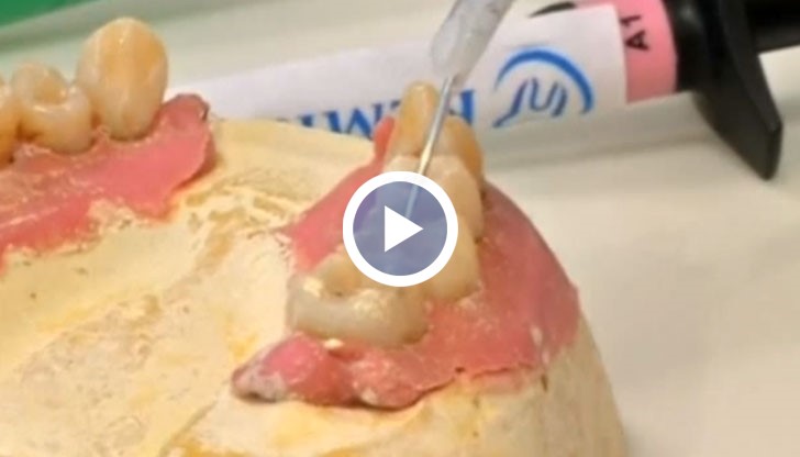 Технологията се основава на естествения процес на реминерализация на зъбите