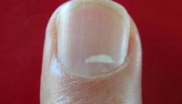 Тези петна се появяват при висок психически стрес Тези петна се появяват при висок психически стрес