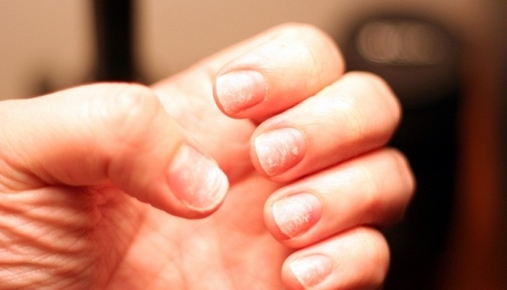 Повърхността на нокътя също може да говори много за здравето на човека