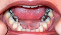 Пломбите вредят на зъбите
