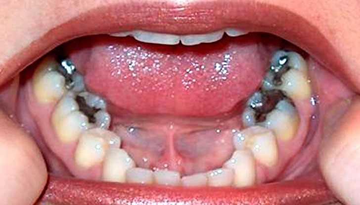 Става дума за случаите, когато пломбирането е извършено некачествено Става дума за случаите, когато пломбирането е извършено некачествено