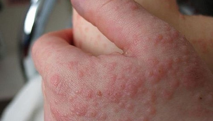 Бум на варицела и скарлатина отчитат районните здравни инспекции в цяла България