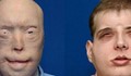 Най-мащабната до днес трансплантация на лице