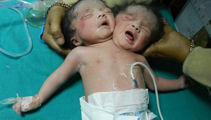 Седмица след раждането си почина момиченцето, родено с две глави и две сърца в Бангладеш