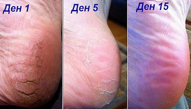 При напукани пети, мазоли, разширени вени и остеохондроза се мажете с паста от аспирин и водка При напукани пети, мазоли, разширени вени и остеохондроза се мажете с паста от аспирин и водка