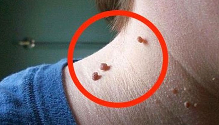 Много от нас знаят от личен опит какво е фибром - малко образование по кожата, което се появява както при мъже, така и жени Много от нас знаят от личен опит какво е фибром - малко образование по кожата, което се появява както при мъже, така и жени