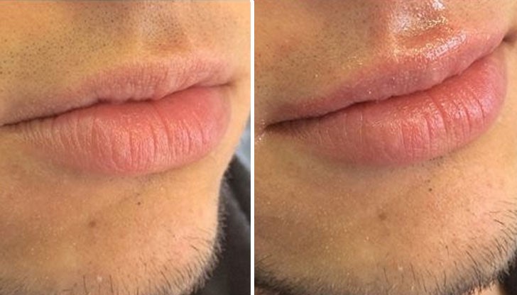 Млади момчета, които не харесват устните си, са се подложили на хиалуронова процедура