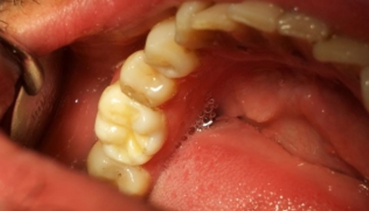 Някои симптоми, свързани със състоянието на устата, могат да кажат много за здравето