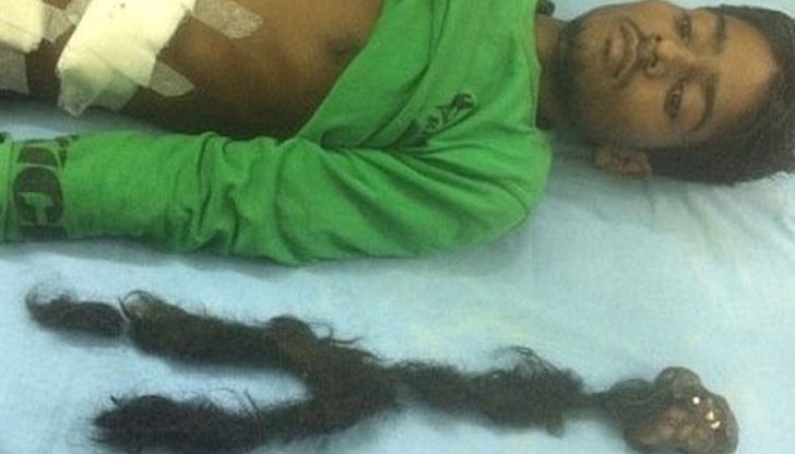 Лекари са открили в тялото на 18-годишен пациент 2.5 килограмов паразит с козина и зъби