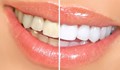 По-бели зъби вкъщи само за 3 минути!