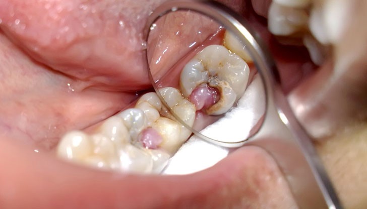 Лесен трик, който ще премахне зъбоболът само за секунди