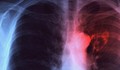 В Русенско намалява броят на заболелите от туберкулоза