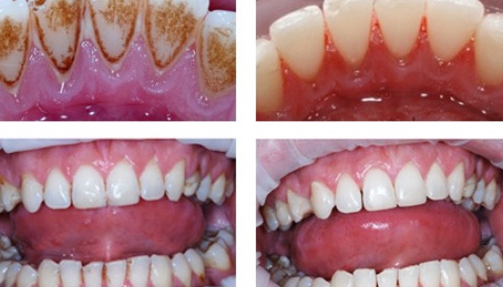 Натрупването на зъбен камък е един от най-често срещаните козметични проблеми