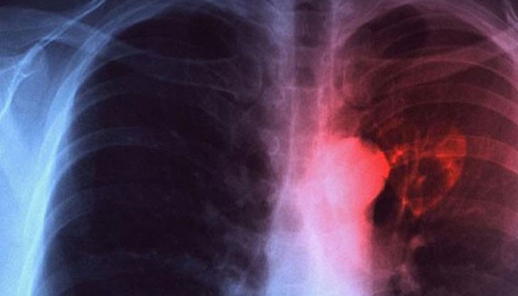 Диагностиката, лечението и профилактиката на туберкулозата у нас са безплатни за всички, независимо от техния здравноосигурителен статус Диагностиката, лечението и профилактиката на туберкулозата у нас са безплатни за всички, независимо от техния здравноосигурителен статус