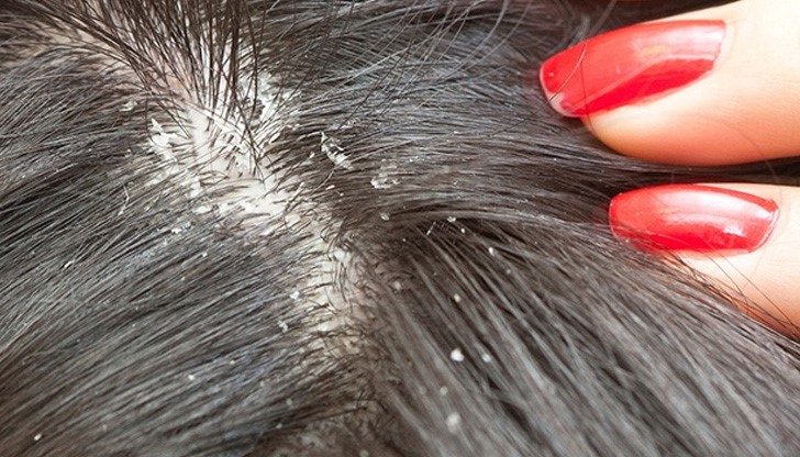 Не е констатирана масова опаразитеност в детски или ученически колектив“, категорични са от отдел „Обществено здраве“ на Община Русе Не е констатирана масова опаразитеност в детски или ученически колектив“, категорични са от отдел „Обществено здраве“ на Община Русе