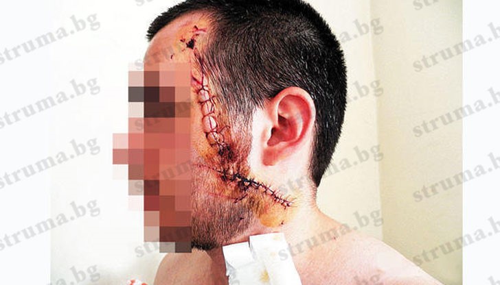 24-годишният К.И. от Благоевград е с жестоко разрязано лице след удар с бутилка по главата