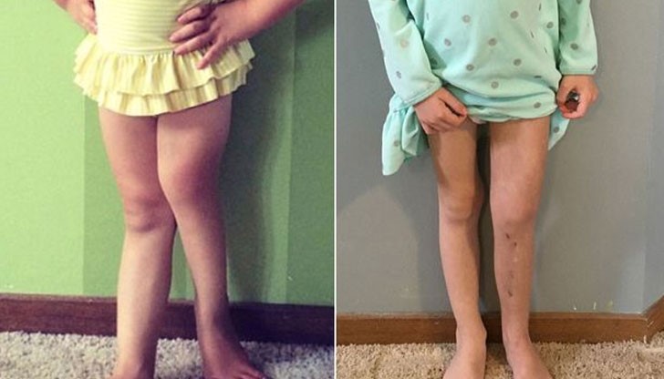 Майката трябвало да избере дали ще ампутира краката на своята дъщеря или да ги чупи по три пъти на ден за 4 месеца