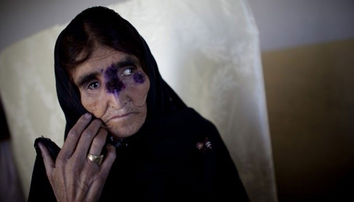 Болестта води до обезобразяване