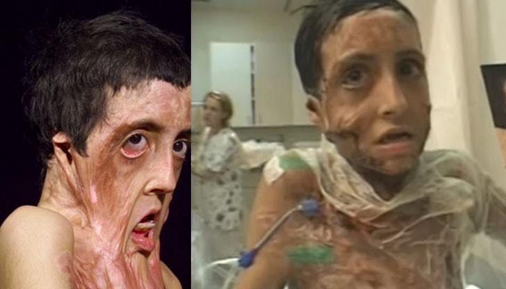 9-годишната Зубаида става жертва на ужасяващ пожар, в който голяма част от лицето и гърдите й са изгорени